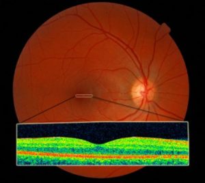 Healthy-Retina-as-seen-with-Retinal-Photography-and-OCT-300x268