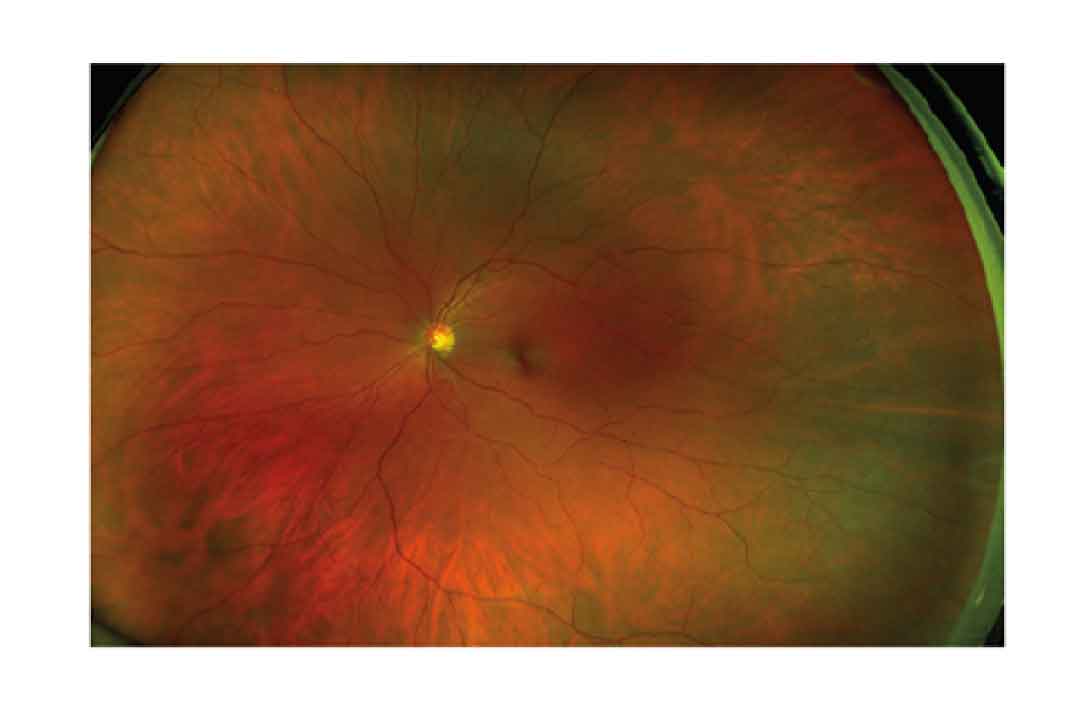 optomap-ultra-widefield-retinal-images