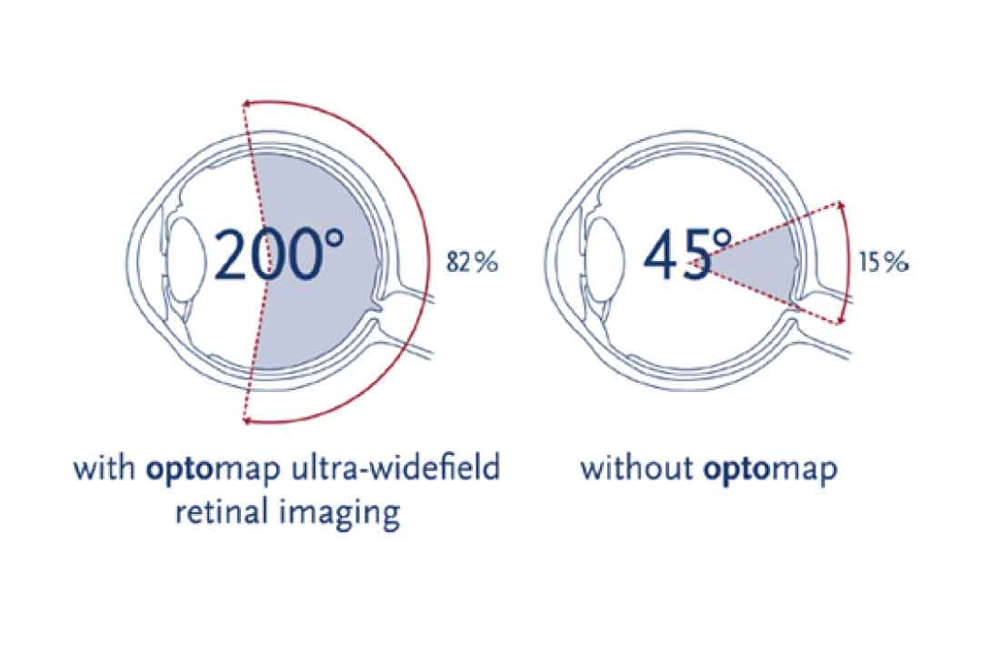 with-and-without-optomap-ultra-widefield-retinal-imaging